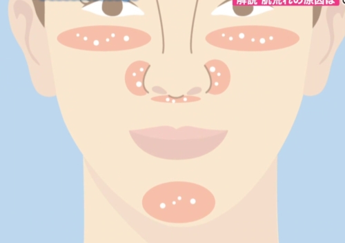 マスクによる肌のトラブルの原因とその予防方法
